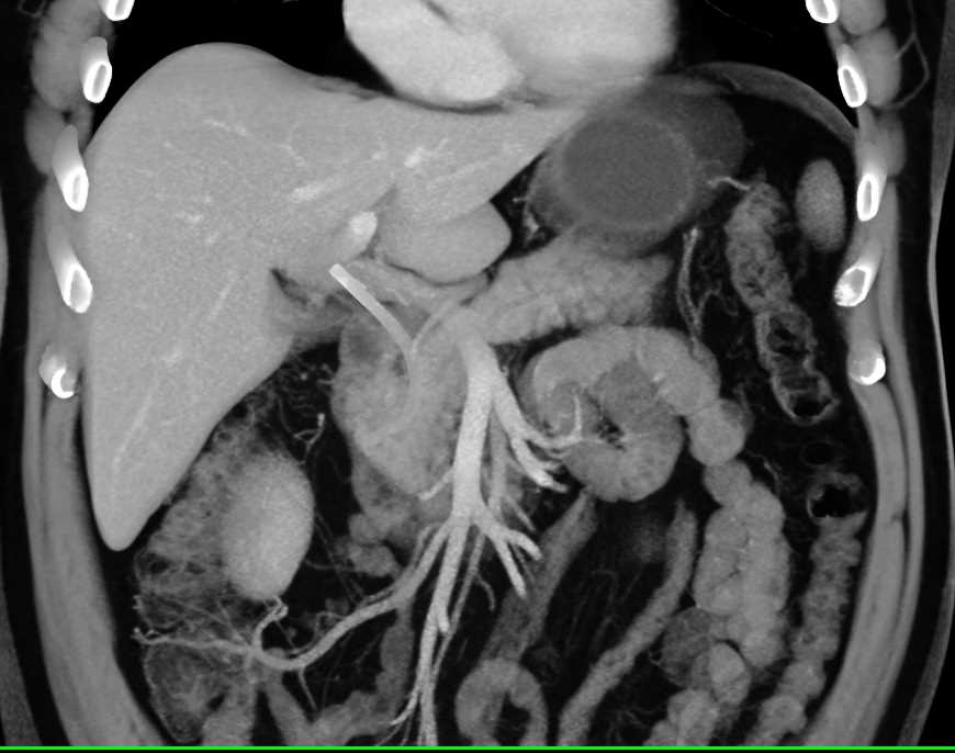 Adenocarcinoma of the Head of the Pancreas - CTisus CT Scan