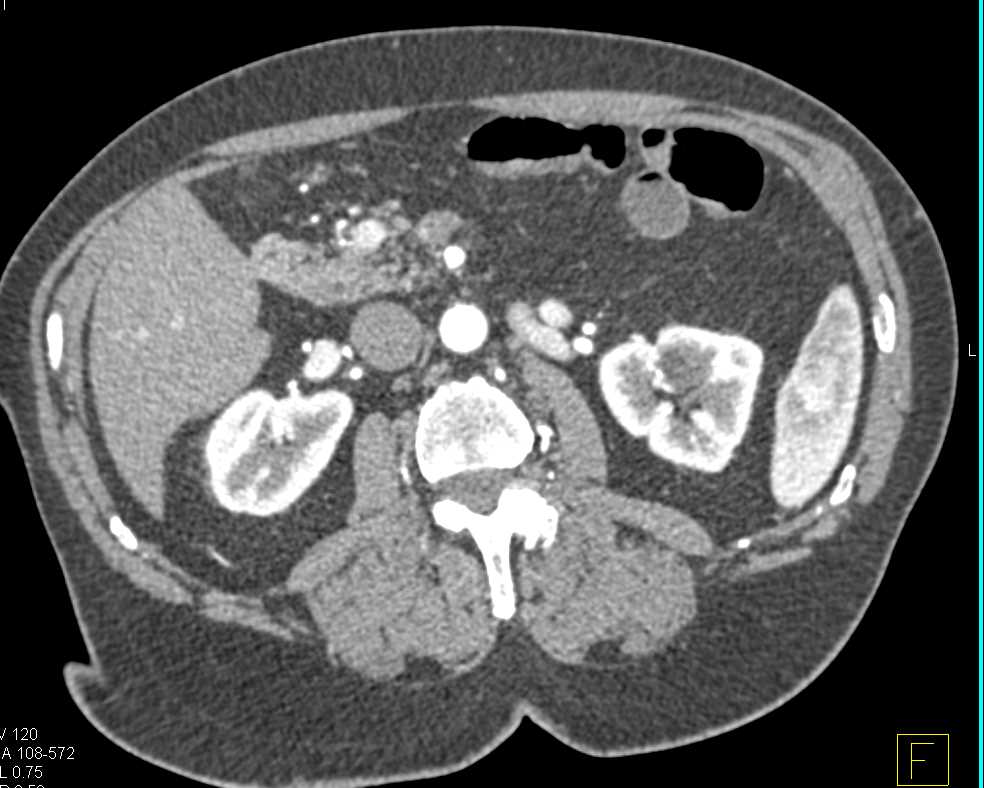 1 cm Neuroendocrine Tumor in the Head of the Pancreas - CTisus CT Scan