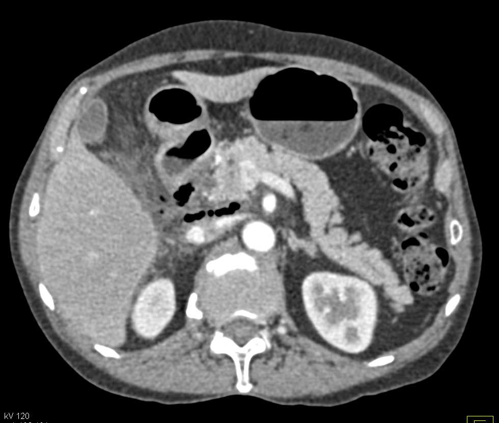 Duodenal Perforation s/p Endoscopic Retrograde Cholangiopancreatography (ERCP) with Secondary Pancreatitis - CTisus CT Scan