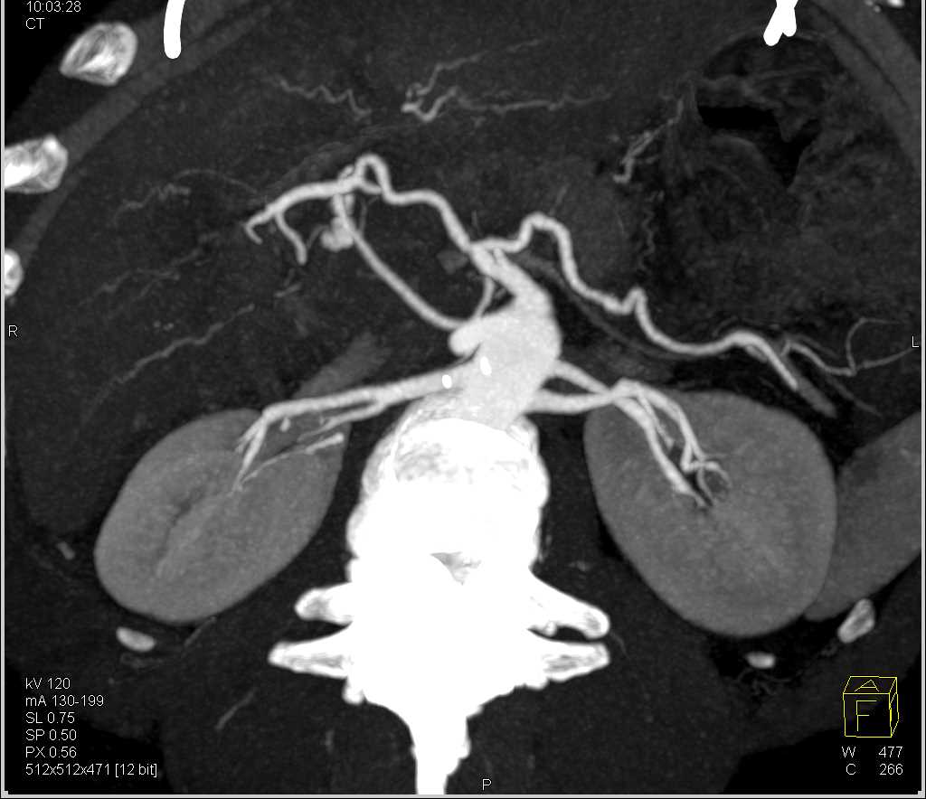 Gastroduodenal Artery (GDA) Bleed Seen on CT Angiogram in a Patient with Pancreatitis - CTisus CT Scan