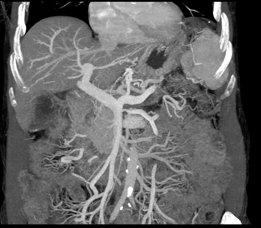 Metastatic Pancreatic Cancer to Liver and Spleen - CTisus CT Scan