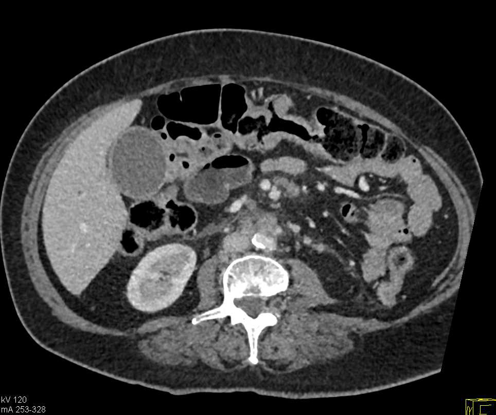 Pancreatic Cancer and Liver Metastases - CTisus CT Scan