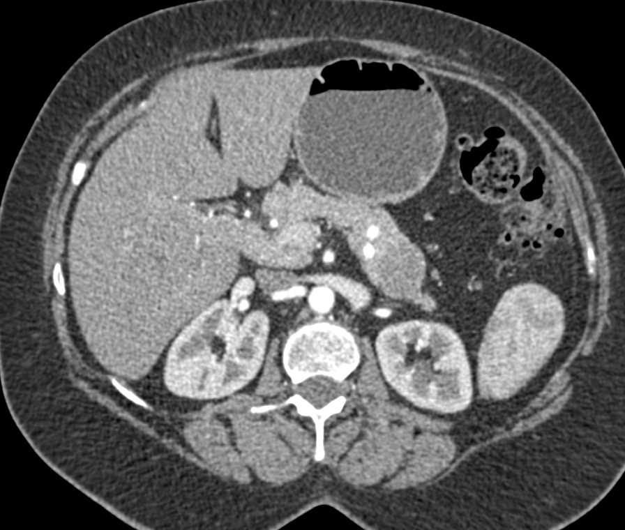 Mucinous Cystadenoma Tail of Pancreas - CTisus CT Scan