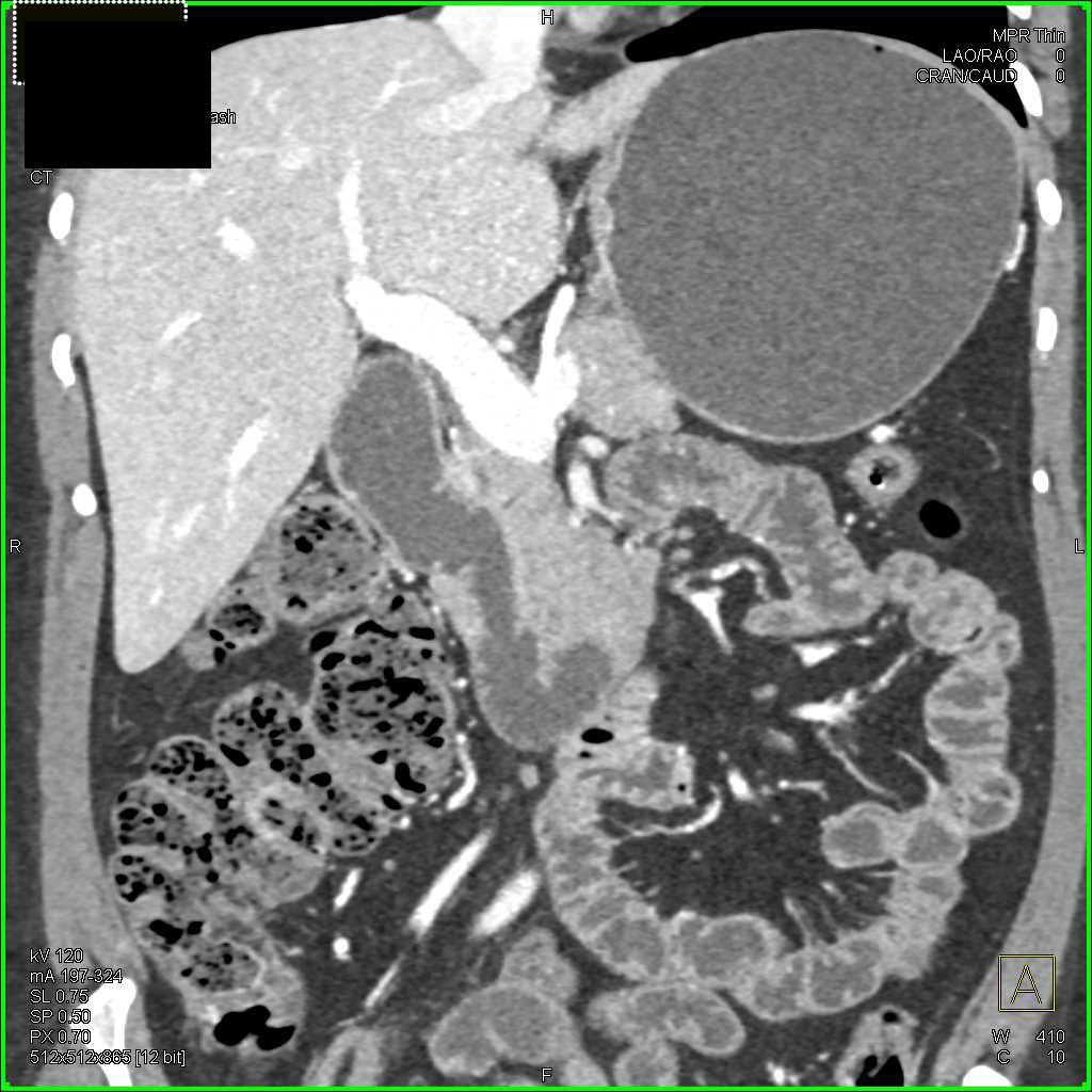 Annular Pancreas Simulates a Duodenal Mass - CTisus CT Scan
