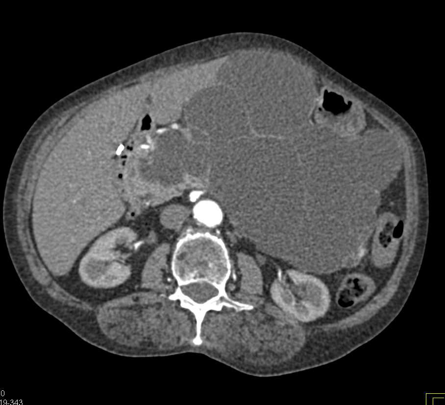 Serous Cystadenoma in Pancreatic Body and Tail - CTisus CT Scan