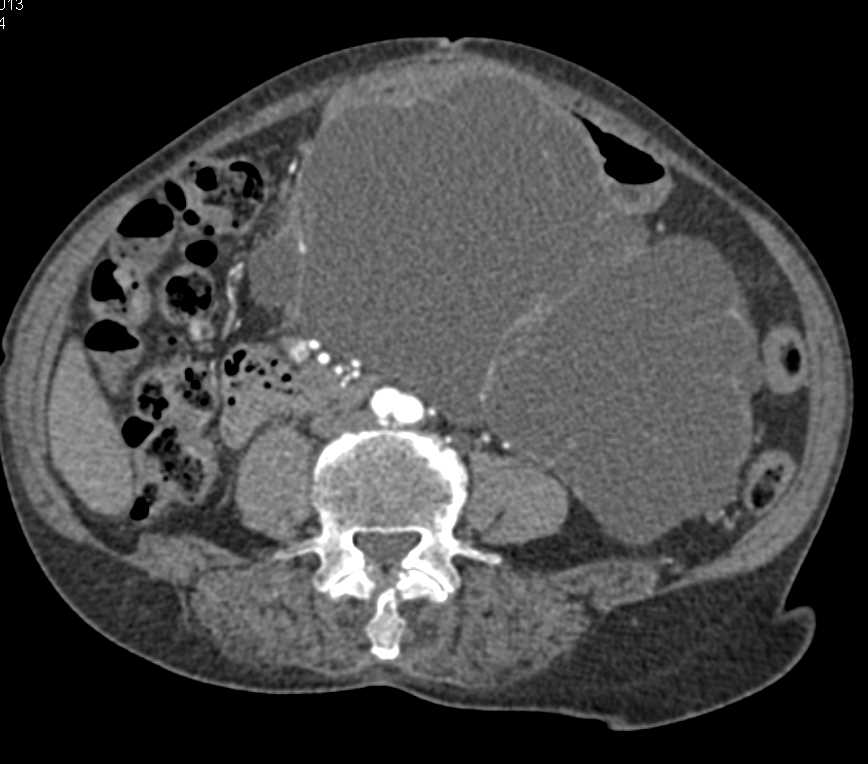Serous Cystadenoma in Pancreatic Body and Tail - CTisus CT Scan