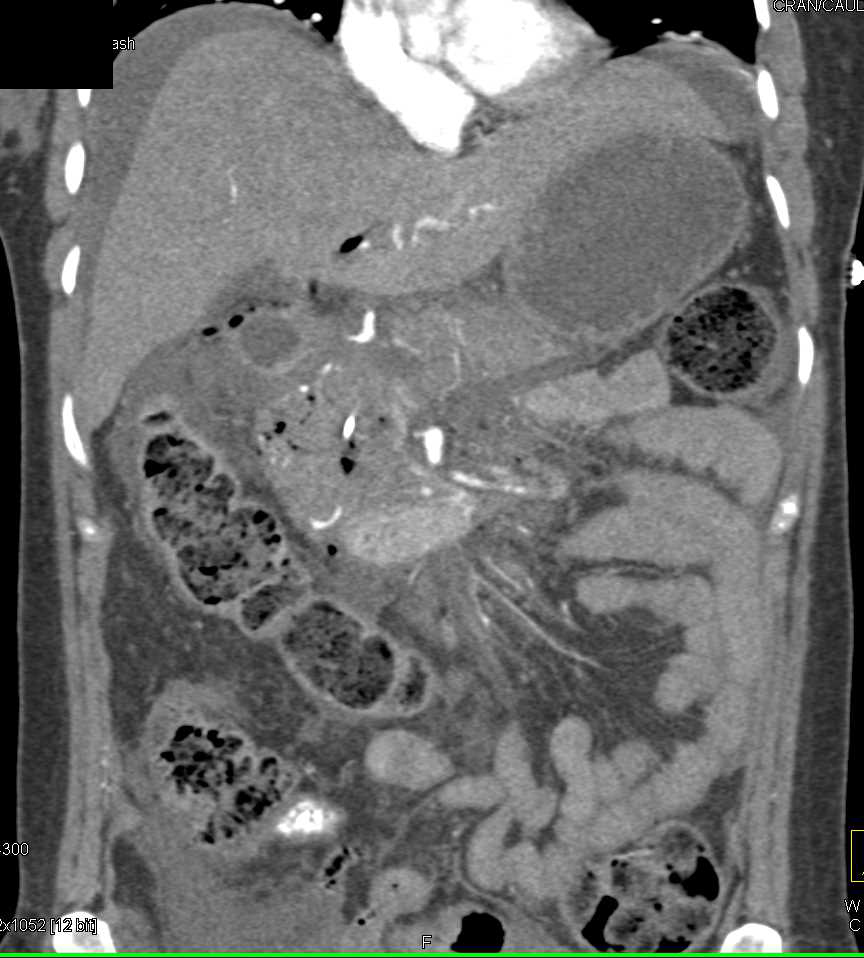 Perforated Duodenum s/p Endoscopic Retrograde Cholangiopancreatography (ERCP) with Acute and Chronic Pancreatitis - CTisus CT Scan
