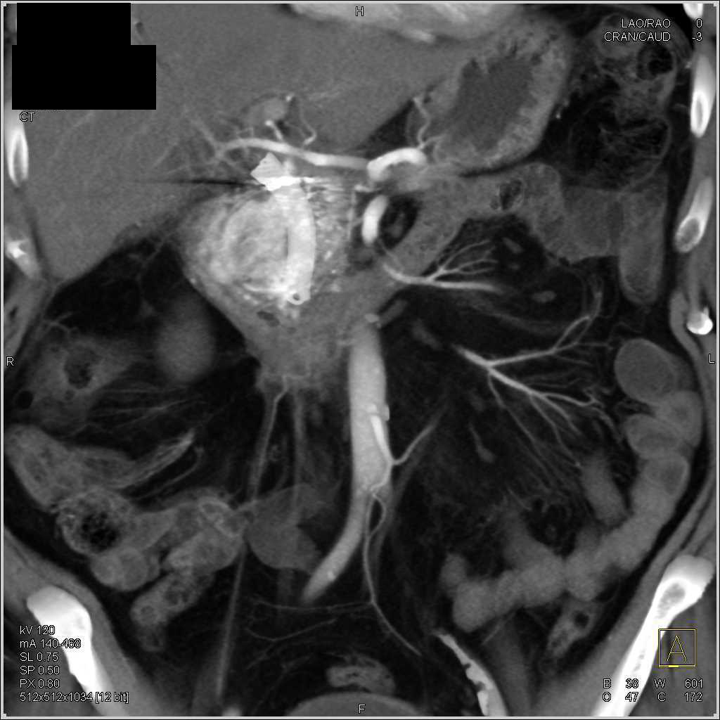 Stent in Common Bile Duct (CBD) with Bleed Near/In Head of Pancreas - CTisus CT Scan
