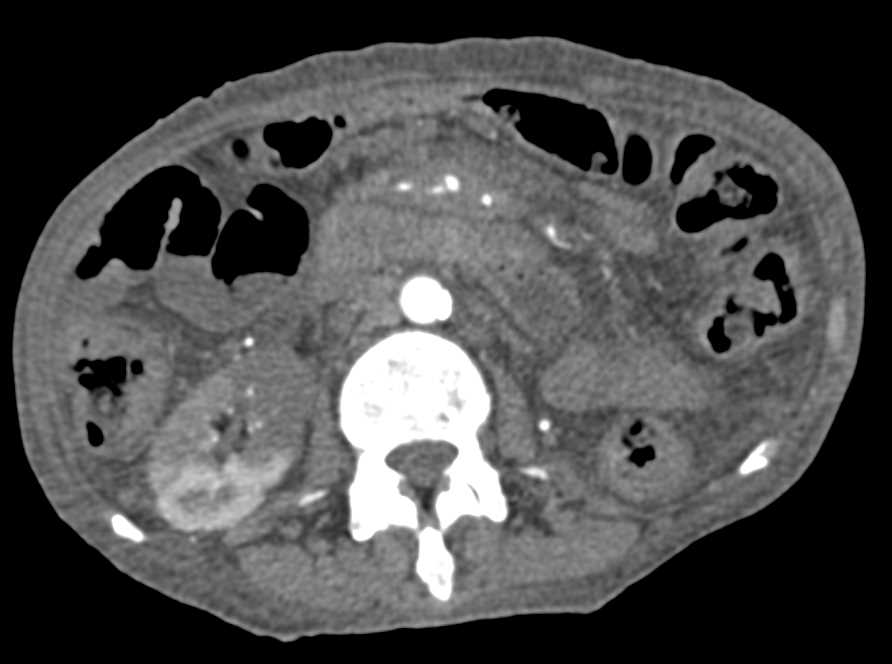 Renal Infarct in a Patient With Spread of Pancreatic Cancer - CTisus CT Scan