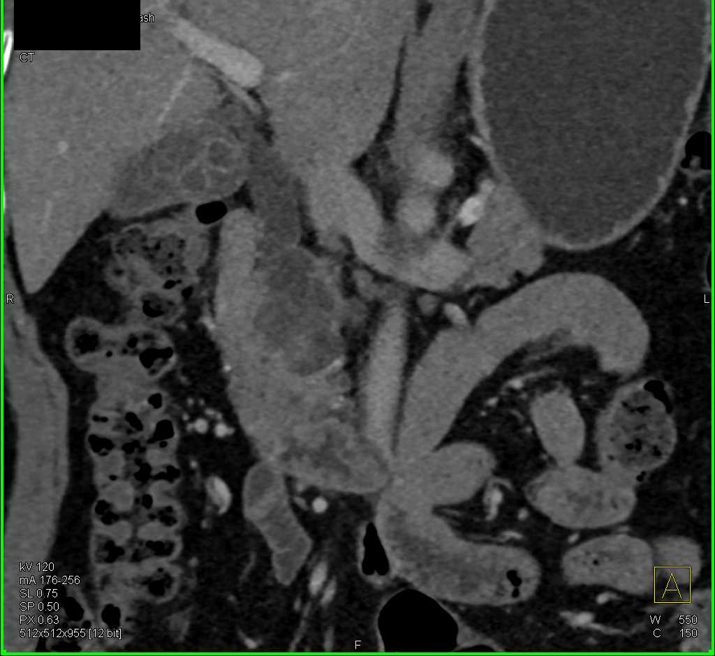 Serous Cystadenoma Head of Pancreas with Dilated Common Bile Duct - CTisus CT Scan