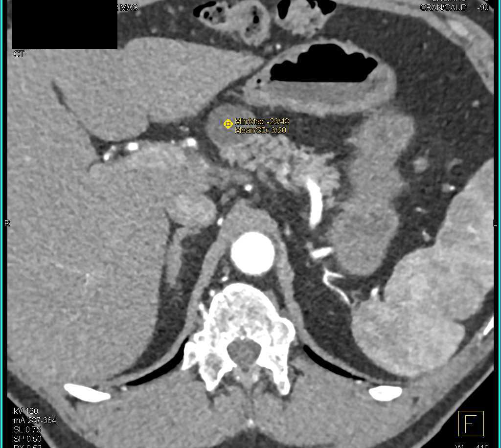 Intraductal Papillary Mucinous Neoplasm (IPMN) Pancreas - CTisus CT Scan