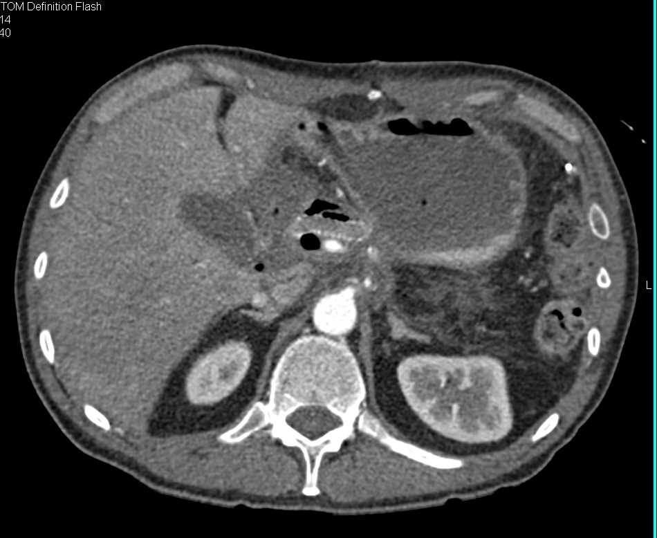 Inflammation Pancreatic Bed s/p Pancreatic Surgery - CTisus CT Scan