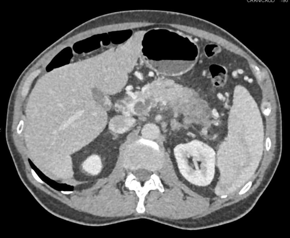 Pancreatic Adenocarcinoma with Portal Vein and Superior Mesenteric Vein (SMV) Involvement - CTisus CT Scan