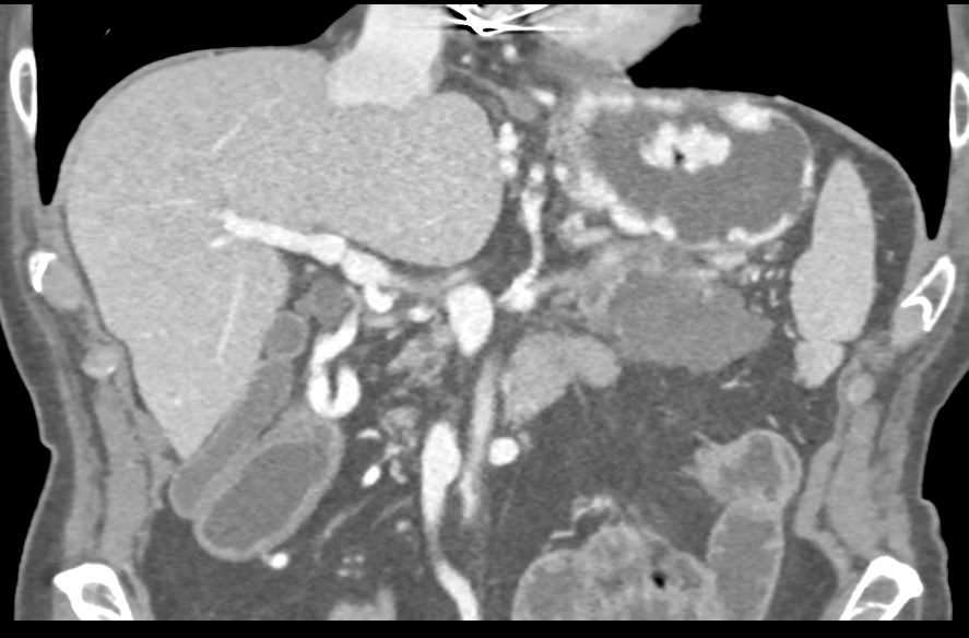 Adenocarcinoma Tail of Pancreas with Vascular Invasion and Large Gastric Varices - CTisus CT Scan