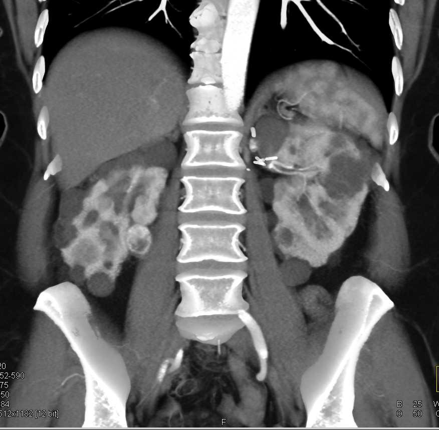 Von Hippel-Lindau syndrome (VHL) with Multiple Renal Carcinoma and Cysts as well as Pancreatic Cysts - CTisus CT Scan