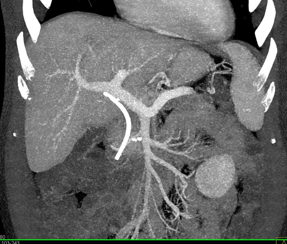 Pancreatic Cancer with Liver Metastases - CTisus CT Scan