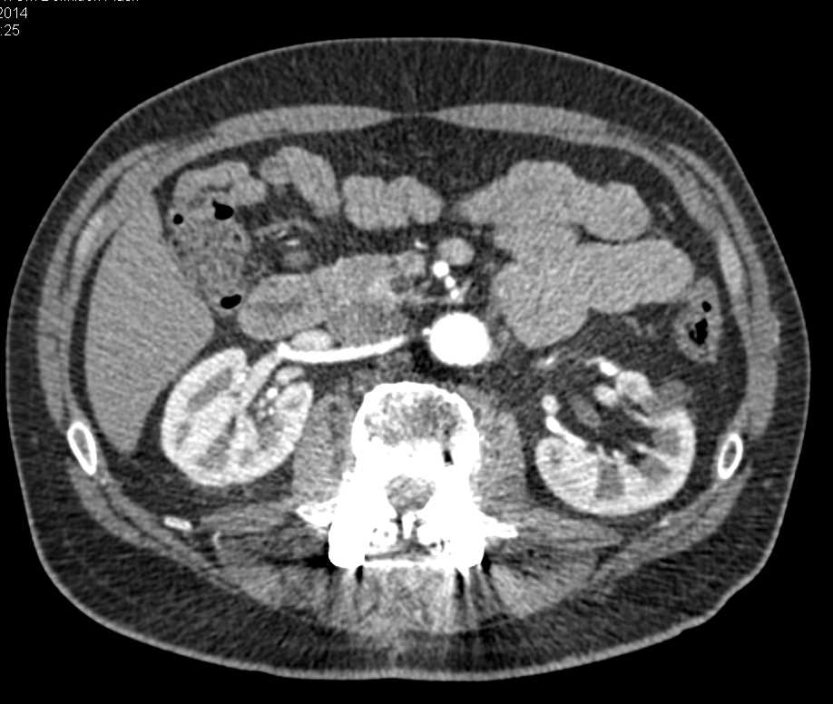 Cystic Neuroendocrine Tumor in the Uncinate Process - CTisus CT Scan