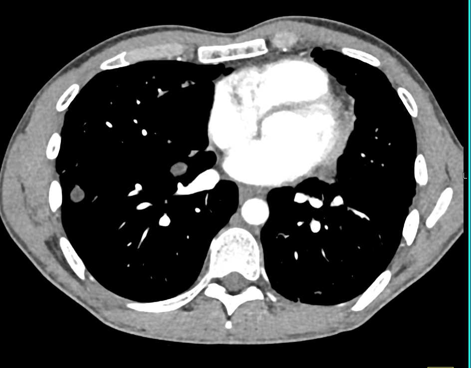 Pancreatic Pseudocysts - CTisus CT Scan