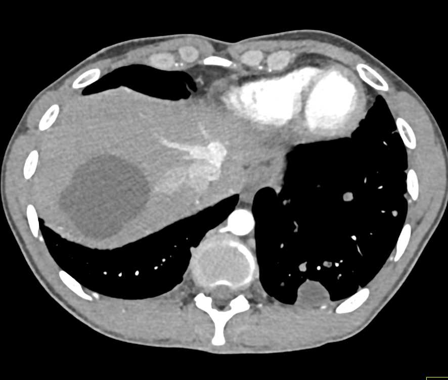 Pancreatic Pseudocysts and Liver Cysts - CTisus CT Scan
