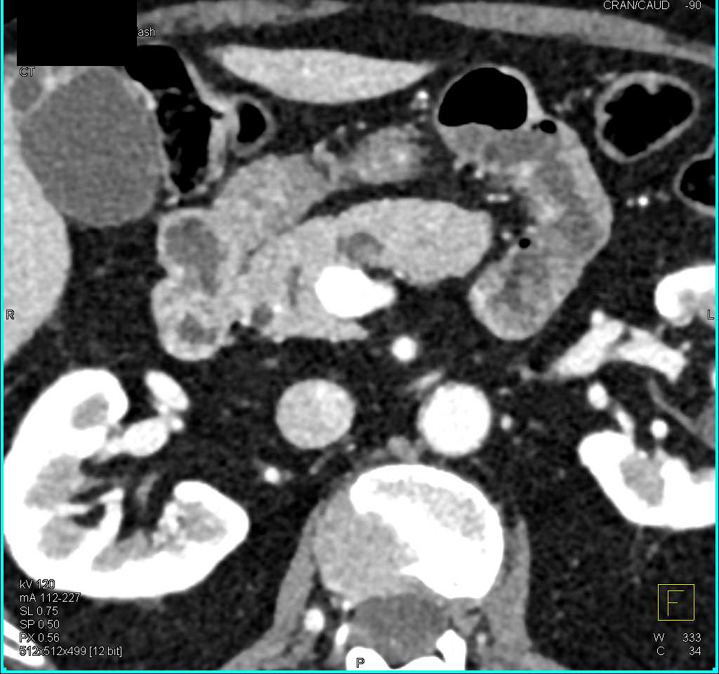 Intraductal Papillary Mucinous Neoplasm (IPMN) with a Small Nodule in the Cystic Lesion - CTisus CT Scan