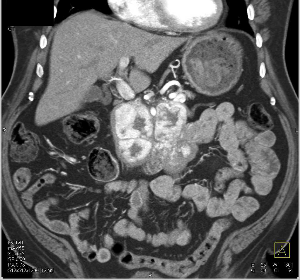 Pancreatic Neuroendocrine Tumor with Bright Blush Including Duodenal Involvement - CTisus CT Scan