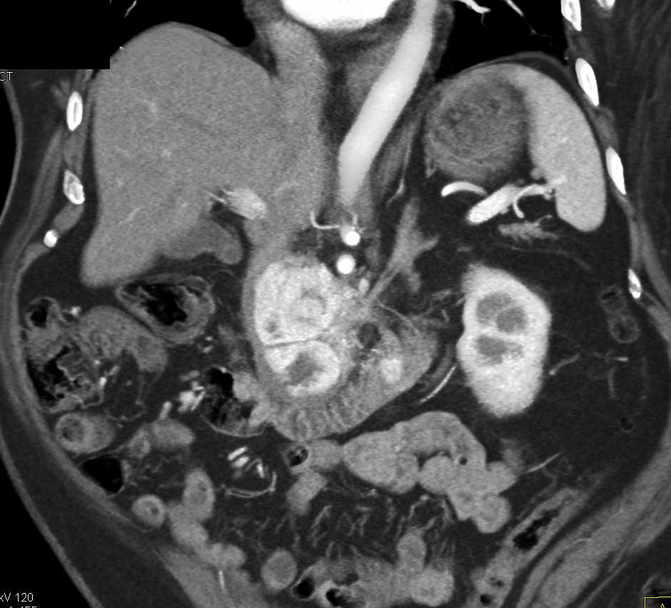 Pancreatic Neuroendocrine Tumor with Bright Blush Including Duodenal Involvement - CTisus CT Scan