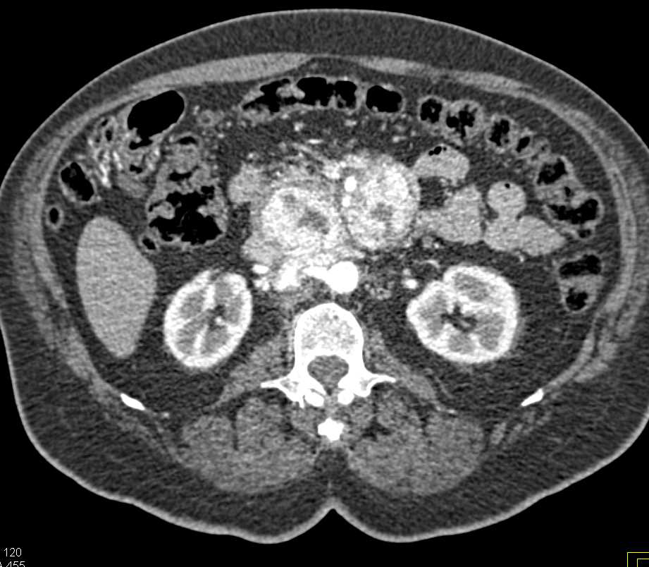 Pancreatic Neuroendocrine Tumor with Bright Blush Including Duodenal Involvement and Liver Metastases - CTisus CT Scan