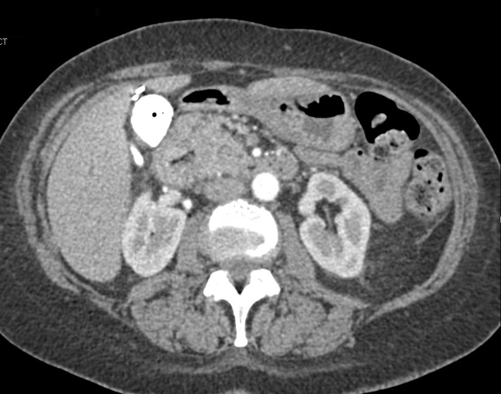 Pancreatic Cancer Obstructs the Common Bile Duct - CTisus CT Scan