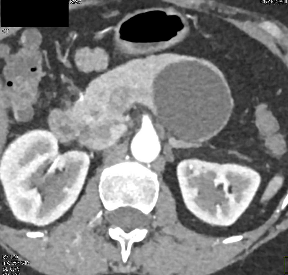 MCN (Mucinous Cystic Neoplasm) of the Tail of the Pancreas - CTisus CT Scan