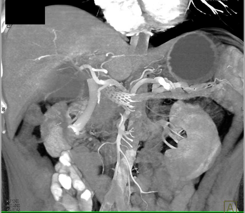 Cystic Metastases to Pancreas from Renal Cell Carcinoma - CTisus CT Scan