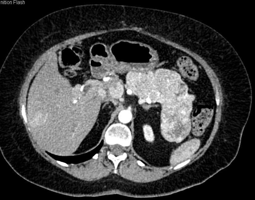 Neuroendocrine Tumor in the  Pancreas with Liver Metastases - CTisus CT Scan