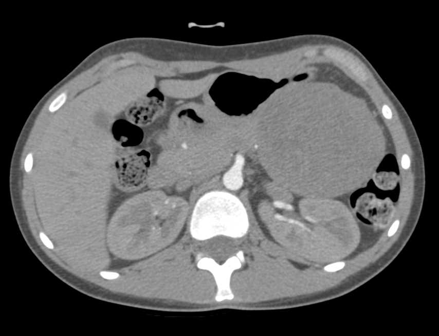 SPEN Tumor Tail of Pancreas - CTisus CT Scan