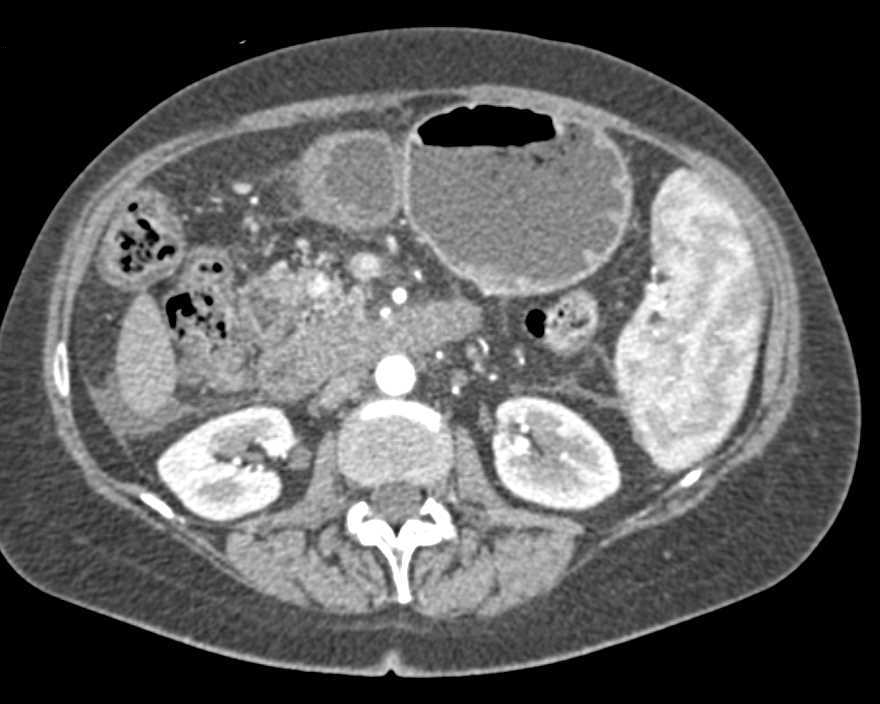 Neuroendocrine Tumor Head of Pancreas with Thick Duodenum - CTisus CT Scan
