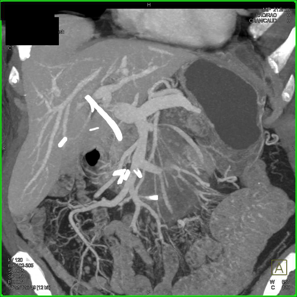 Pancreatitis with Inflammation in the Mesentery - CTisus CT Scan