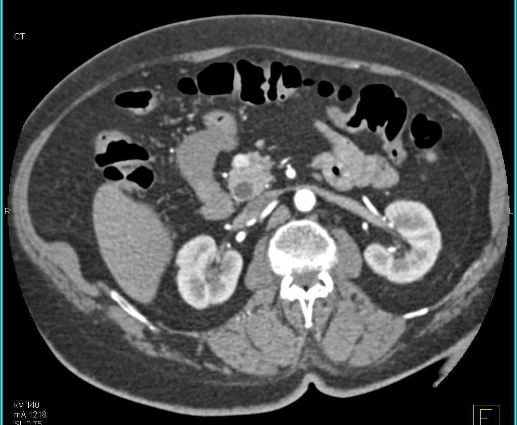 1cm Neuroendocrine Tumor in the Head of the Pancreas - CTisus CT Scan