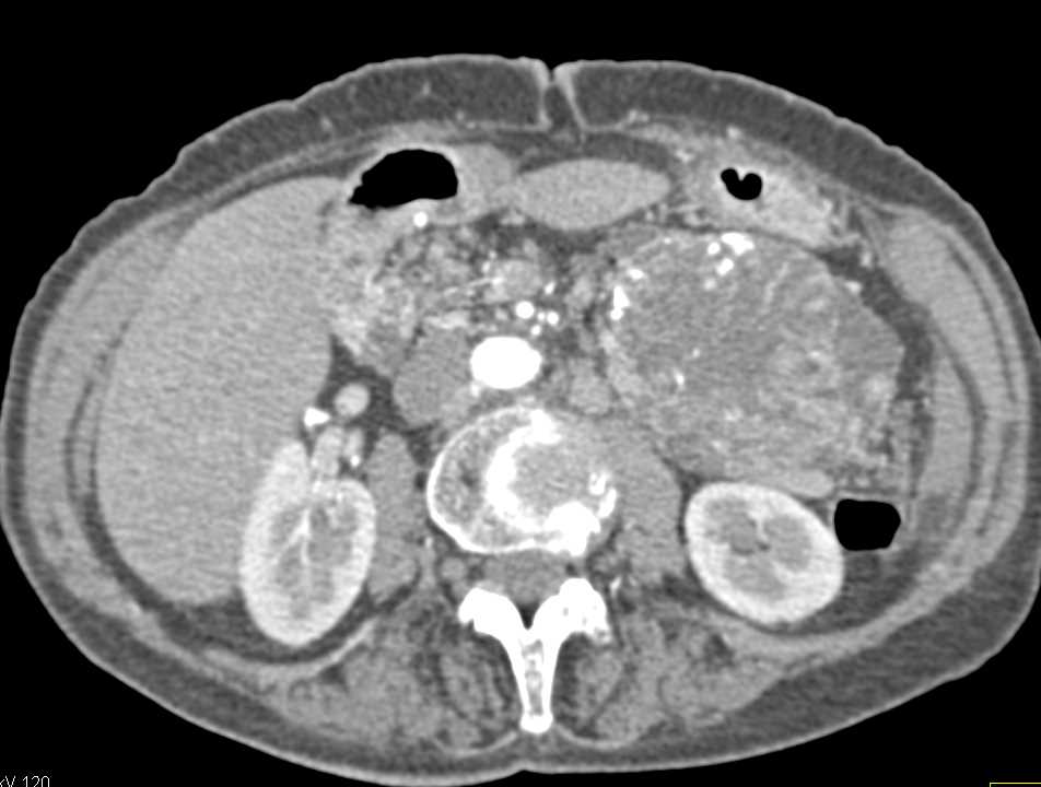 SPEN Tumor Tail of the Pancreas - CTisus CT Scan