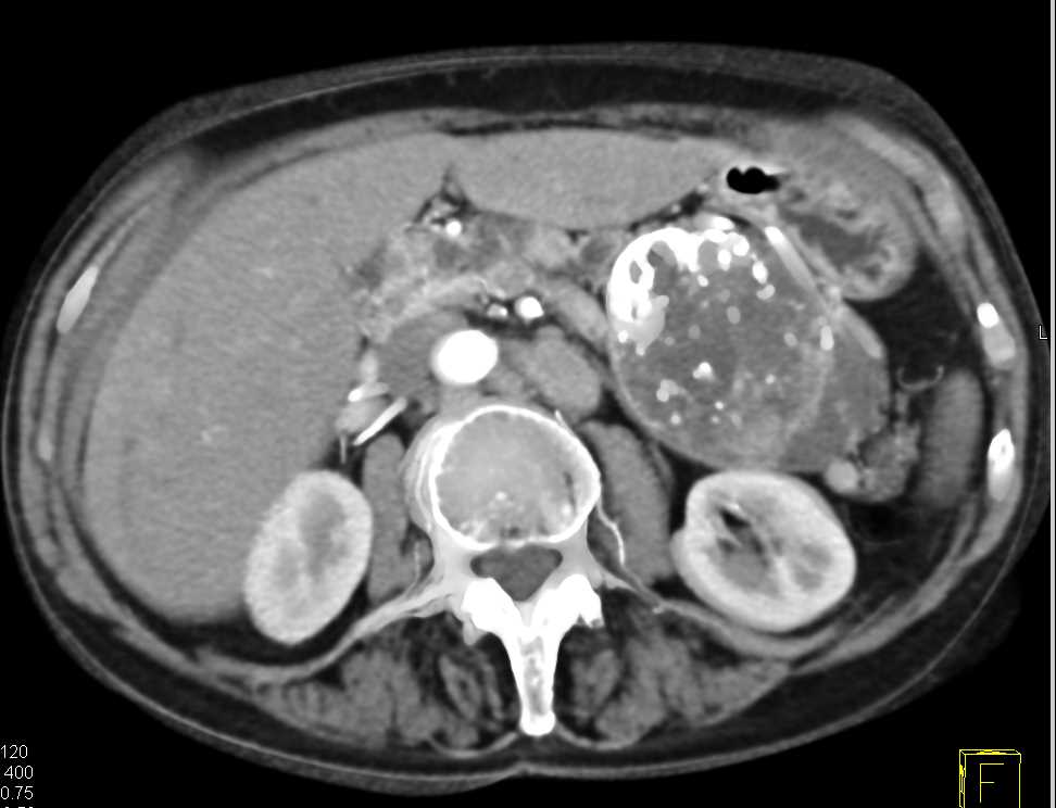 SPEN Tumor Tail of the Pancreas - CTisus CT Scan