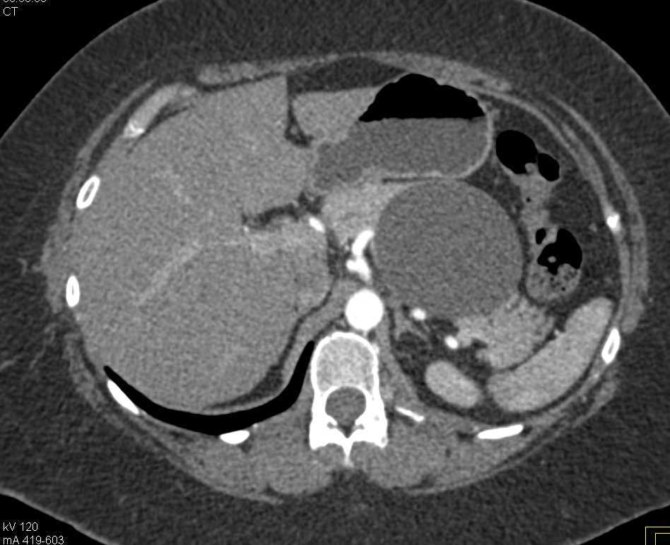 Serous Cystadenoma Tail of Pancreas - CTisus CT Scan