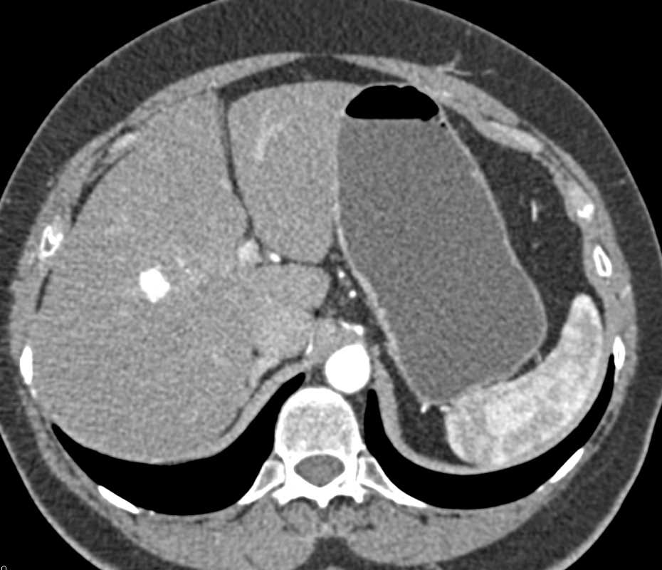 Neuroendocrine Tumor Head of Pancreas - CTisus CT Scan