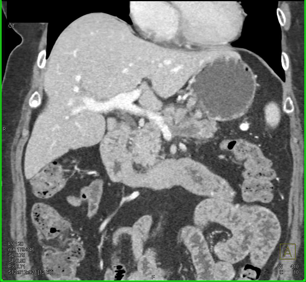 Pancreatic Adenocarcinoma in the Body/Tail of the Pancreas - CTisus CT Scan
