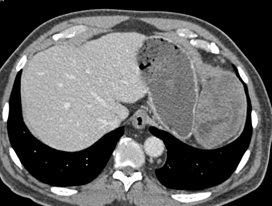 Omental Infarct Left Upper Quadrant Following Distal Pancreatectomy and Splenectomy - CTisus CT Scan