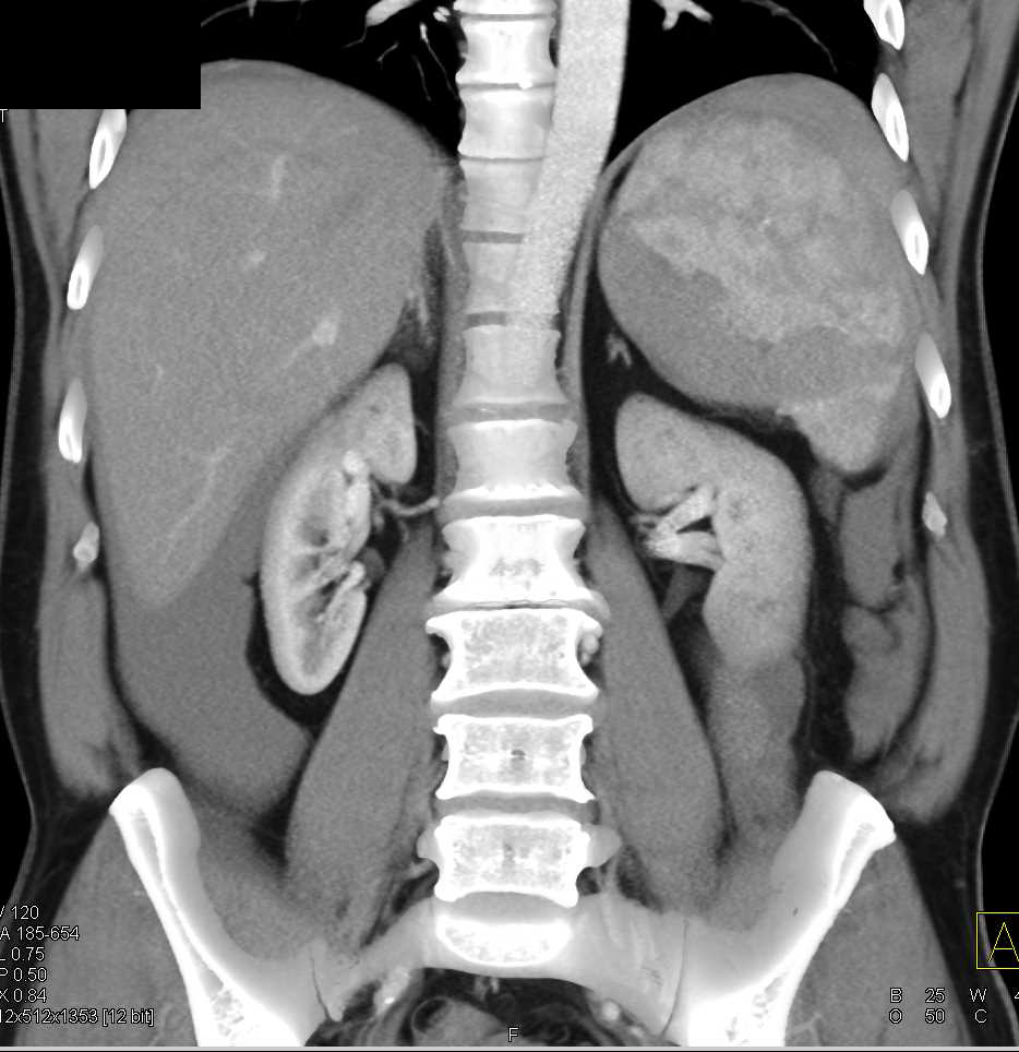 Neuroendocrine Tumor Pancreas Which is Very Vascular and Spontaneous Rupture of the Spleen - CTisus CT Scan