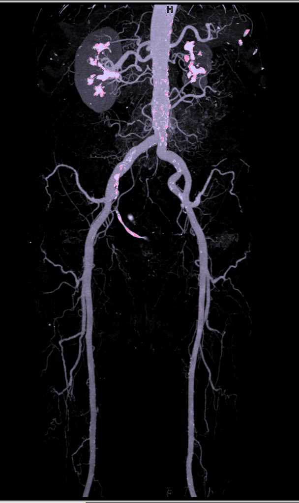 Pancreatic Cancer with Normal Vascular Map - CTisus CT Scan