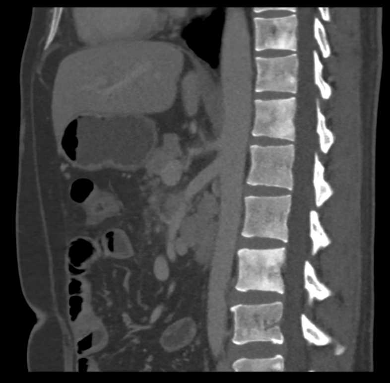 Neuroendocrine Tumor Pancreas Which is Very Vascular and Metastases to Pelvis and Bone - CTisus CT Scan