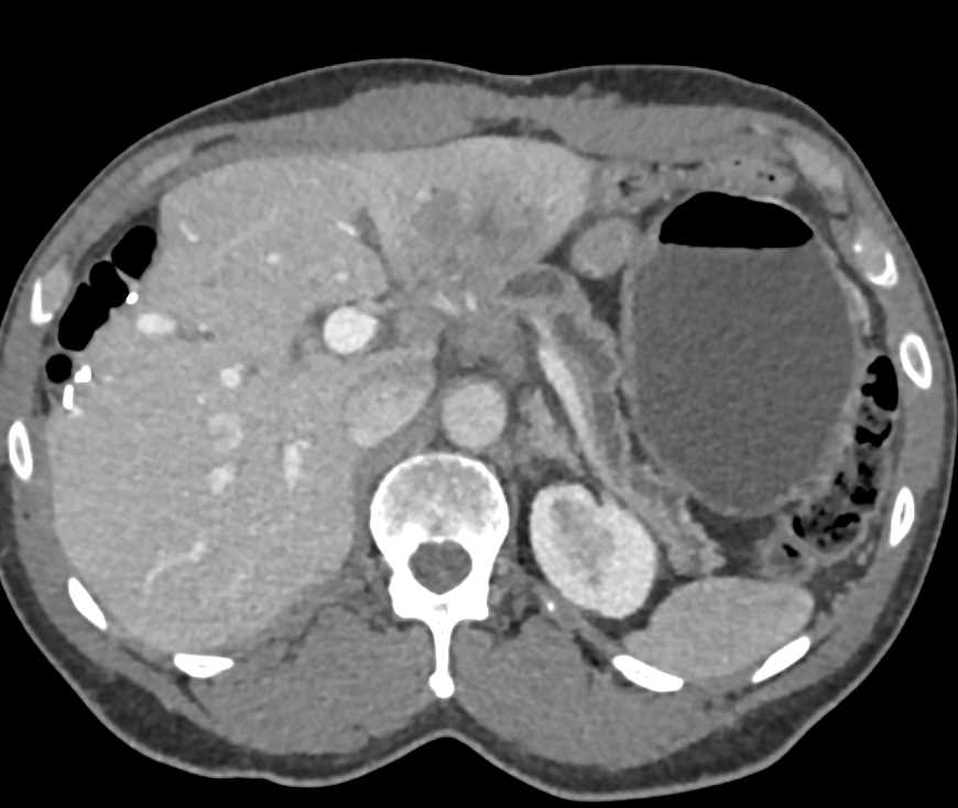 Pancreatic Cancer Obstructs the Pancreatic Duct - CTisus CT Scan
