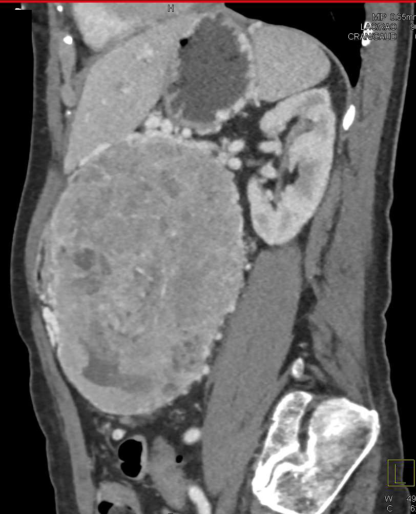 Pancreatic Neuroendocrine Tumor with Vascular Invasion - CTisus CT Scan