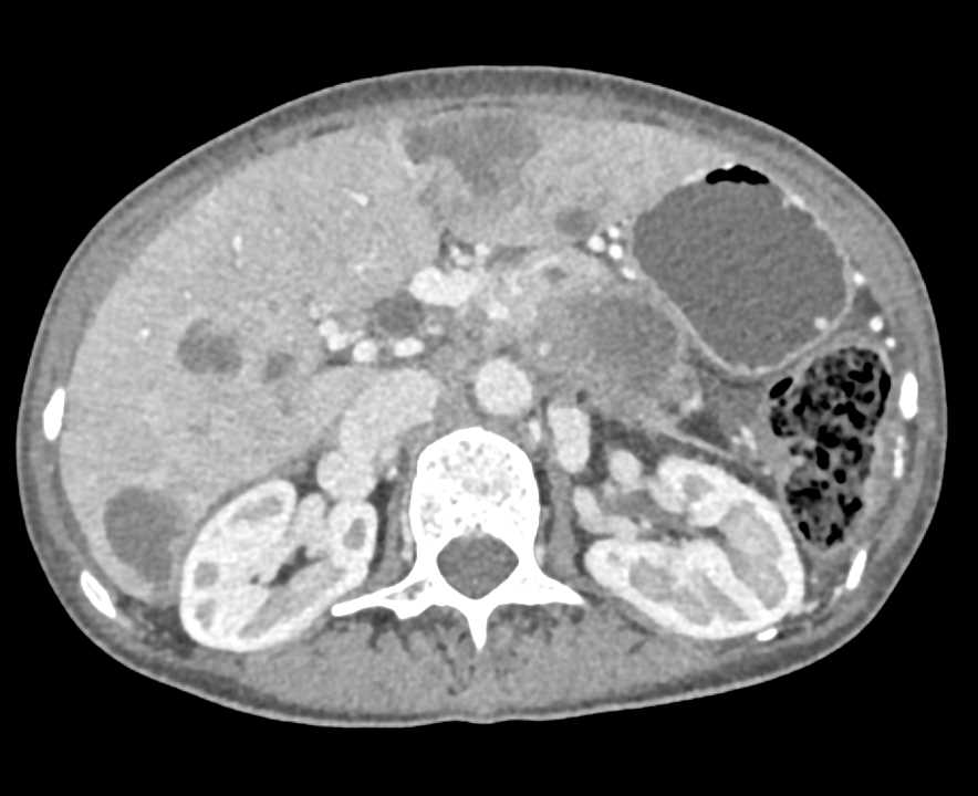 Pancreatic Cancer with Liver Metastases and Vascular Invasion - CTisus CT Scan