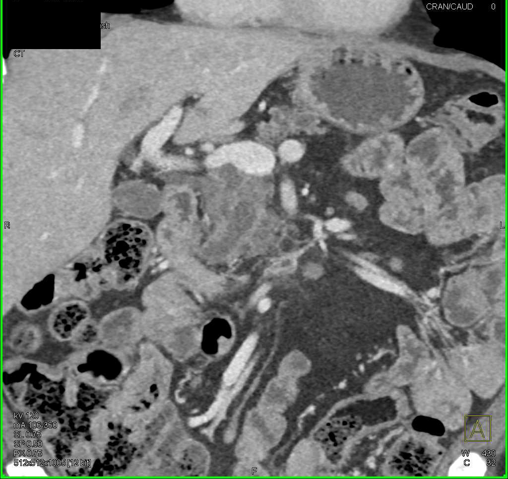 Pancreatic Adenocarcinoma Arises from an Intraductal Papillary Mucinous Neoplasm (IPMN) - CTisus CT Scan