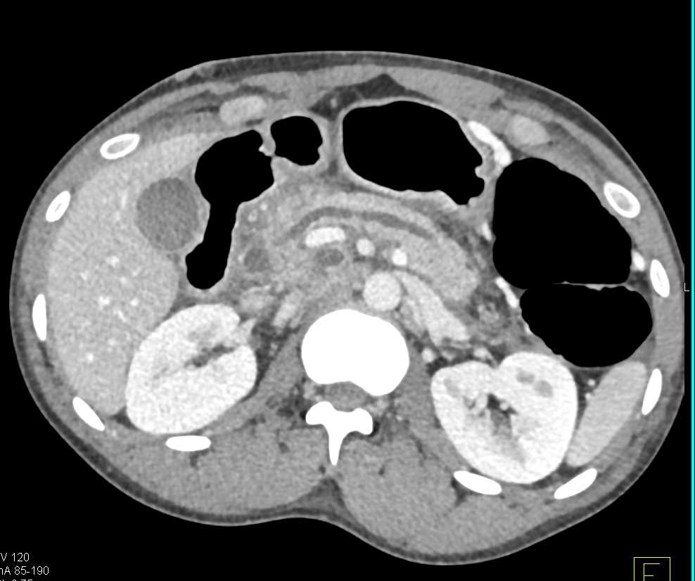 Acute Pancreatitis with Pseudocyst - CTisus CT Scan