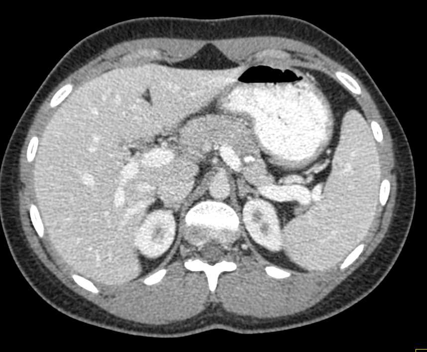 Neuroendocrine Tumor in the Tail of the Pancreas - CTisus CT Scan